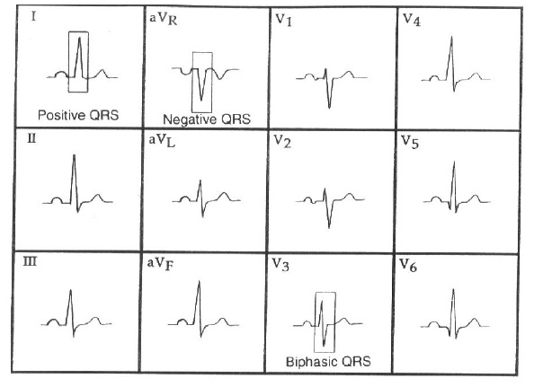 normal_qrs.jpg