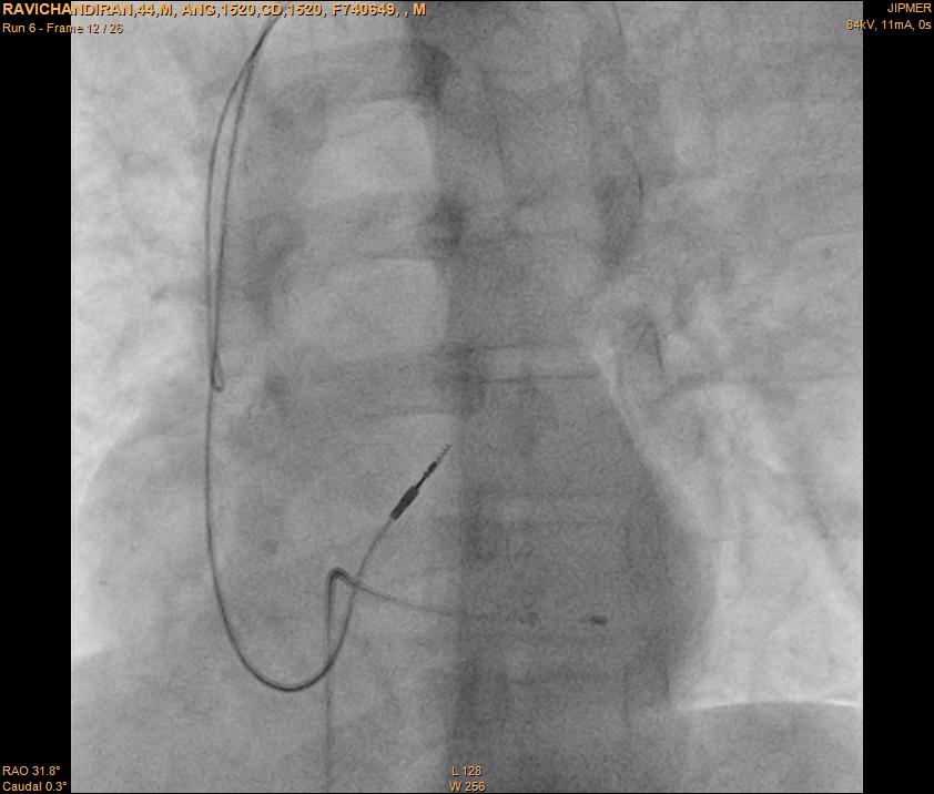 rvot_before_screw.jpg