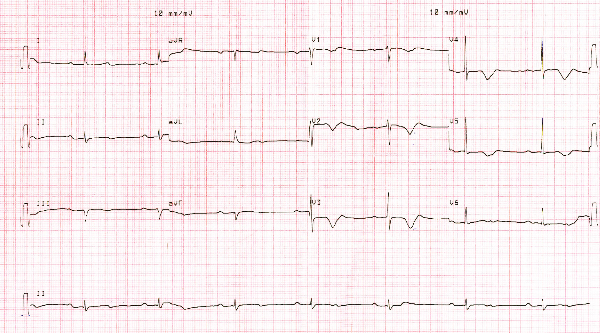 infra_his_ECG.jpg
