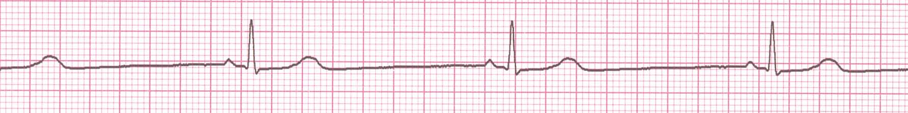sinus_bradycardia.jpg