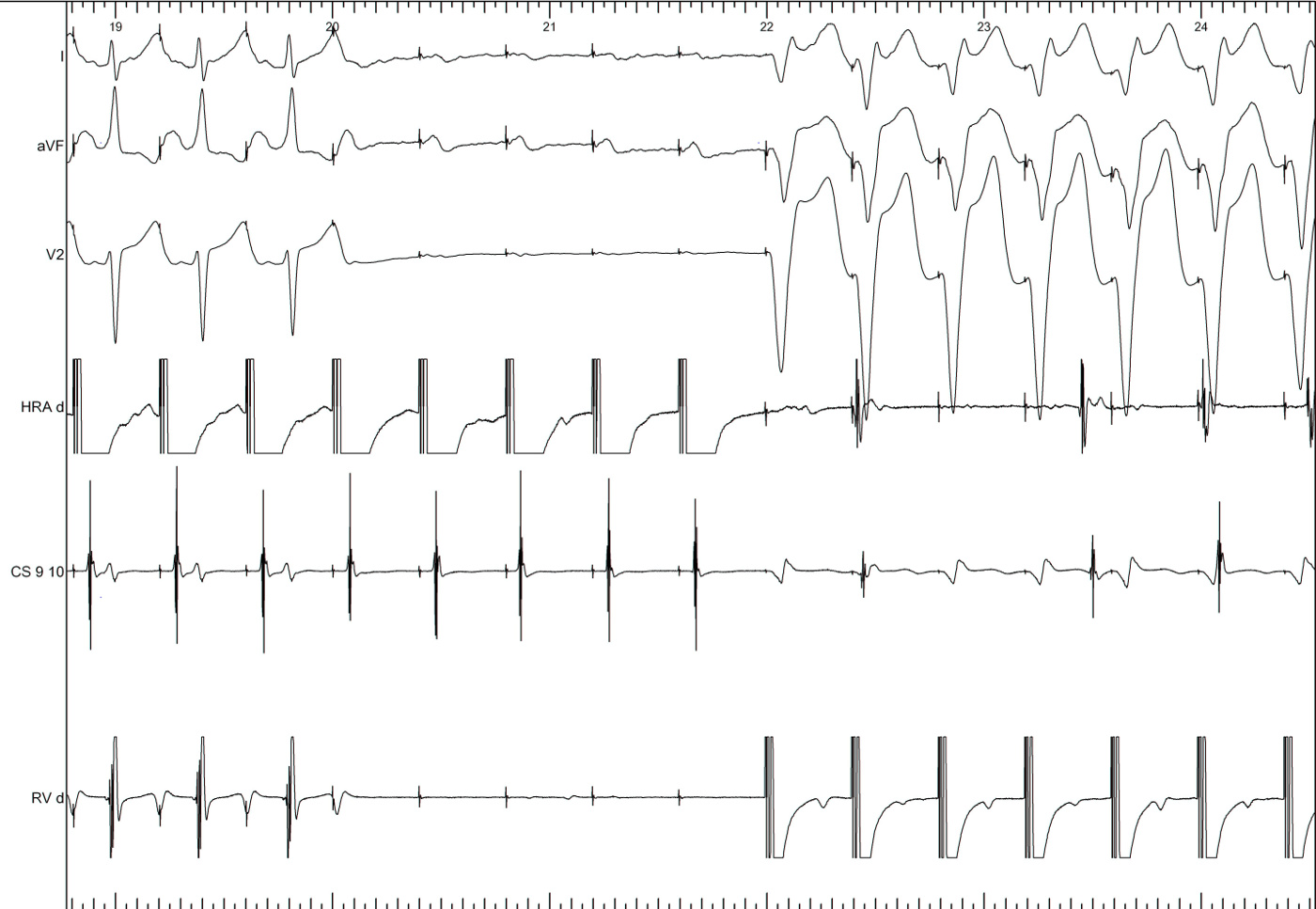 adenosine_post_abl_ramesh_2013-12.jpg
