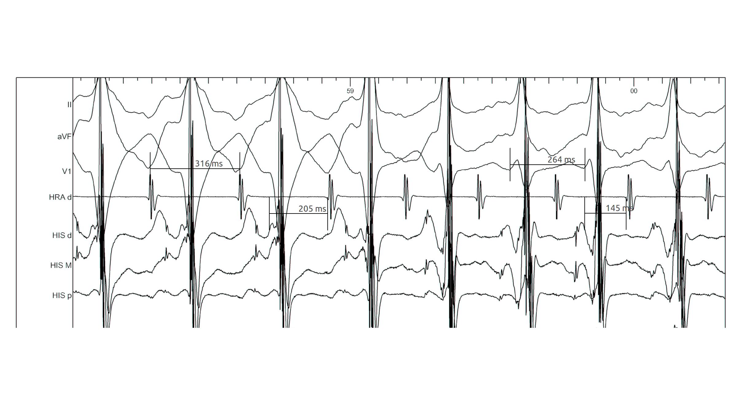 lbbb_narrow_measurements.jpg