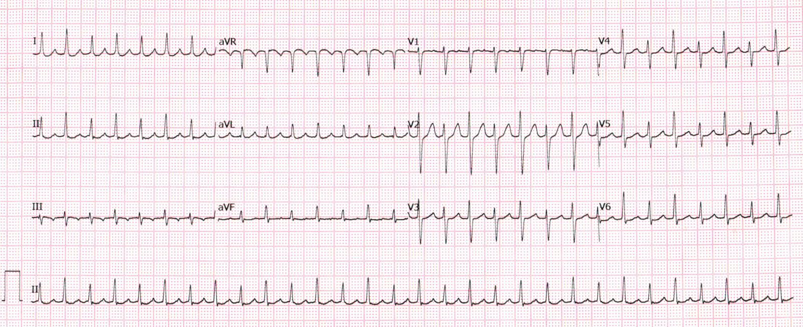gunasundari_tachy_qrs_alternans.jpg
