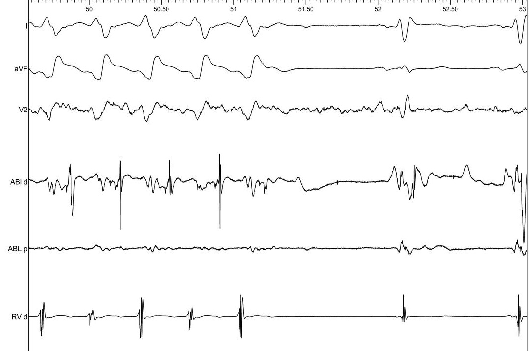 08_VT_termination_ablation.jpg
