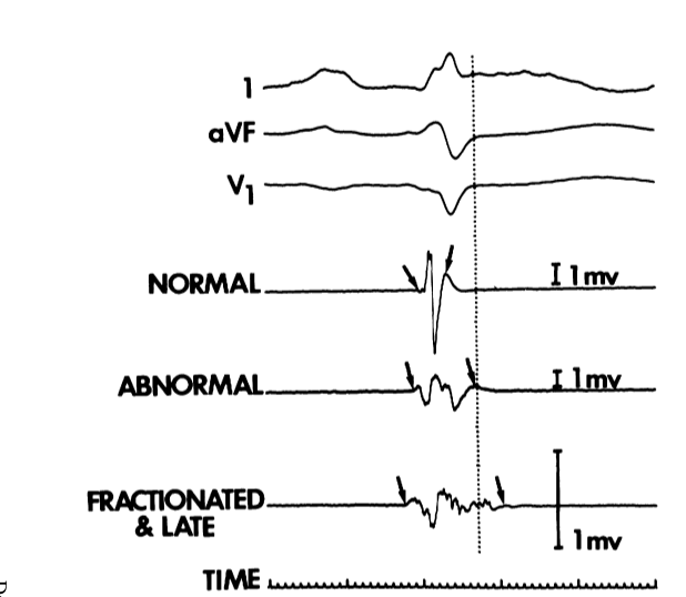 josephson_sinus_abnormal.png