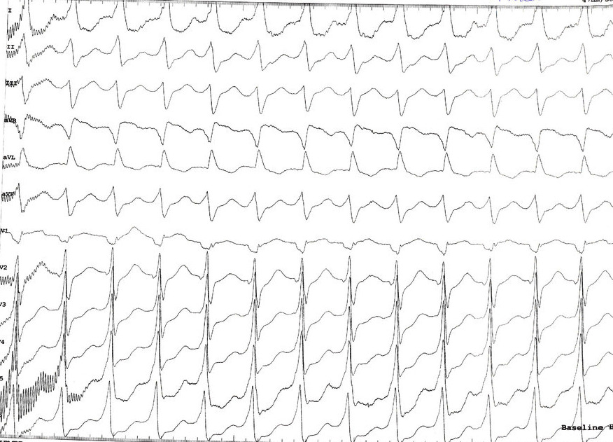 tachycardia_ecg.jpg