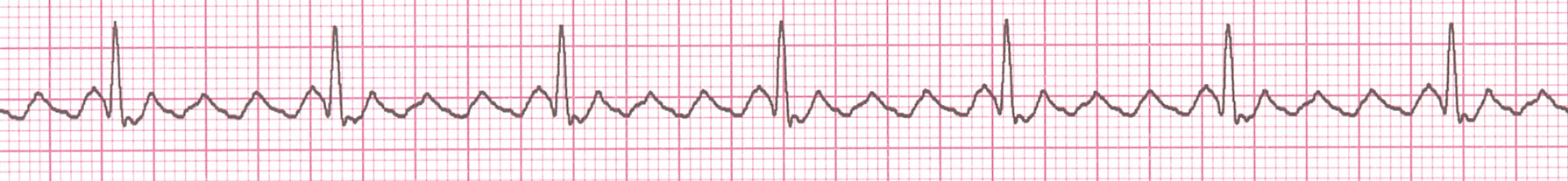 atrial_flutter.jpg