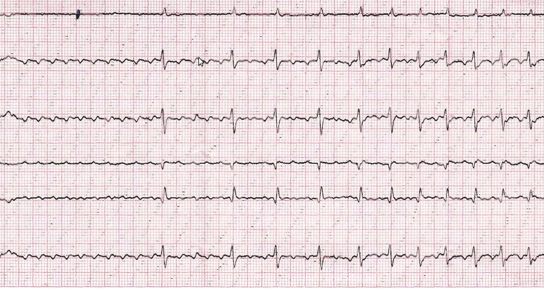 atrial_flutter2_adenosine.png