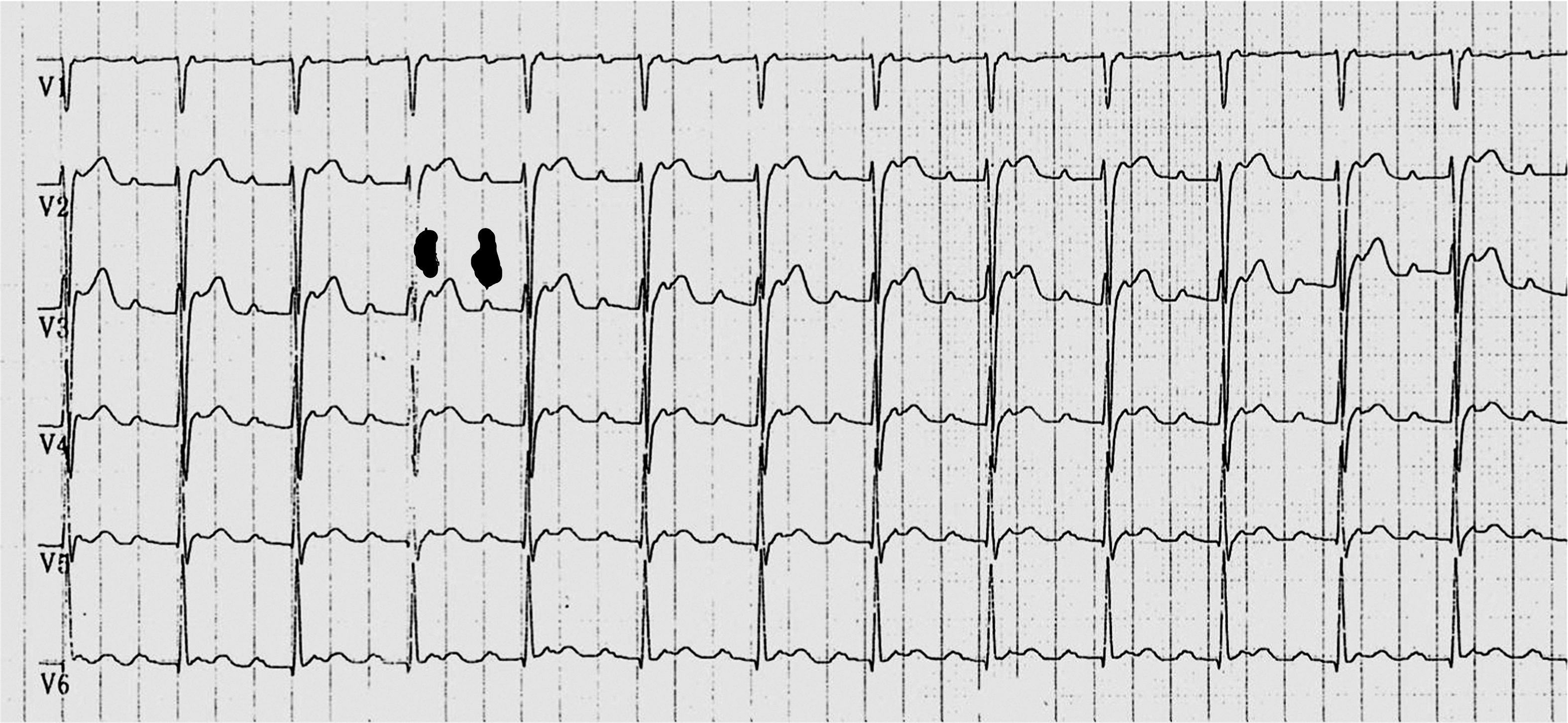 atrial_tachycardia.jpg