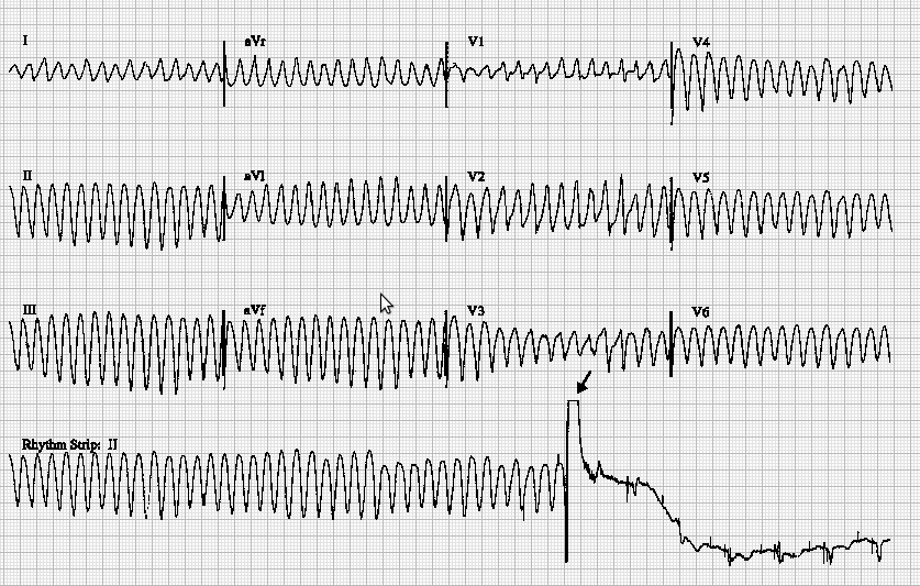 ventricular_fibrillation.png