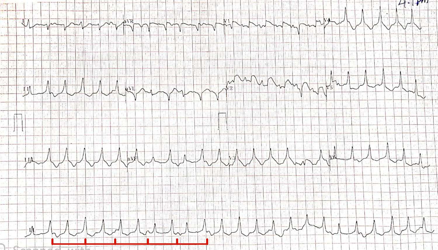 vt_ecg_m.jpg