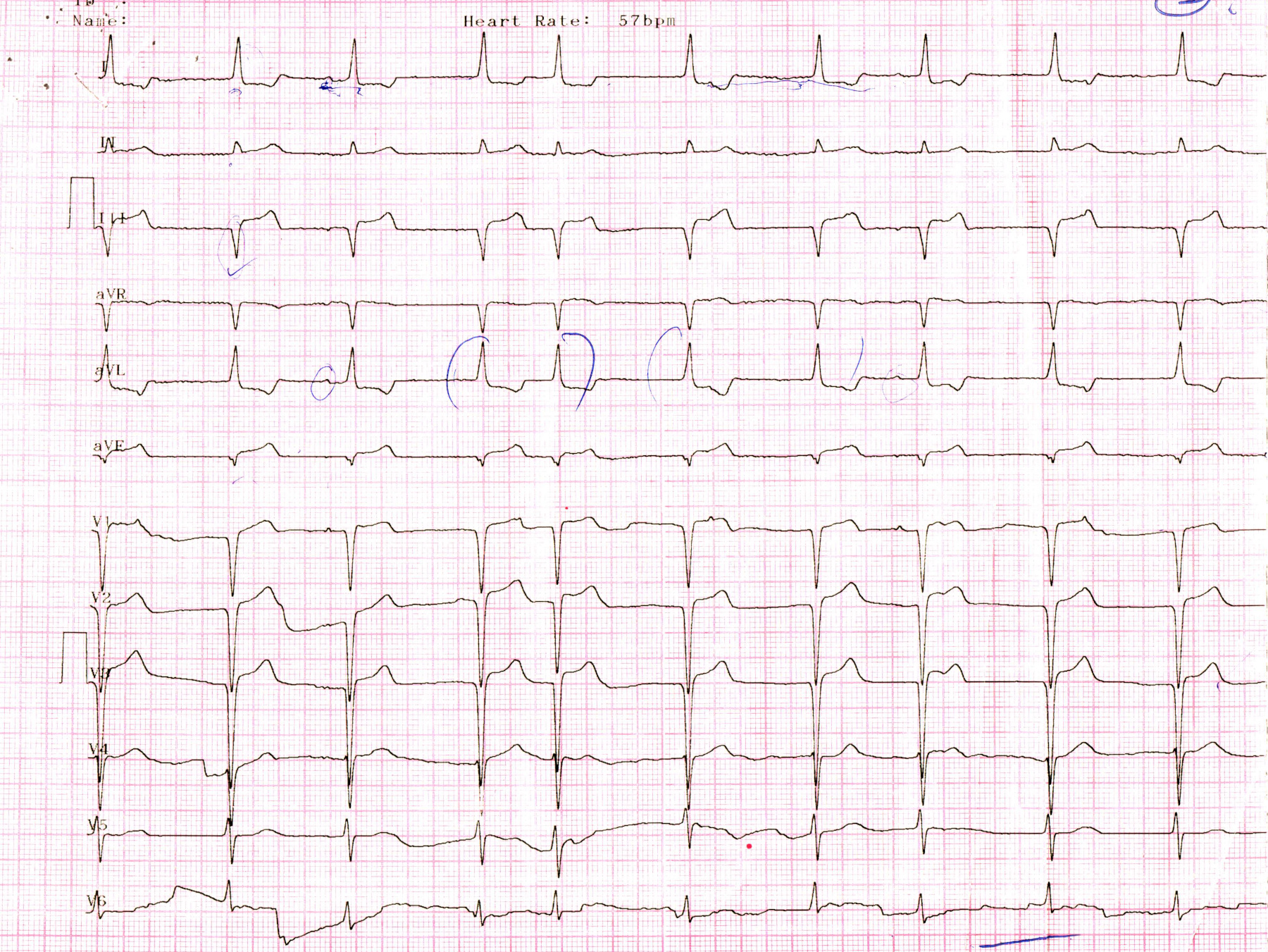 sinus_brady_junctional_track_p.jpg