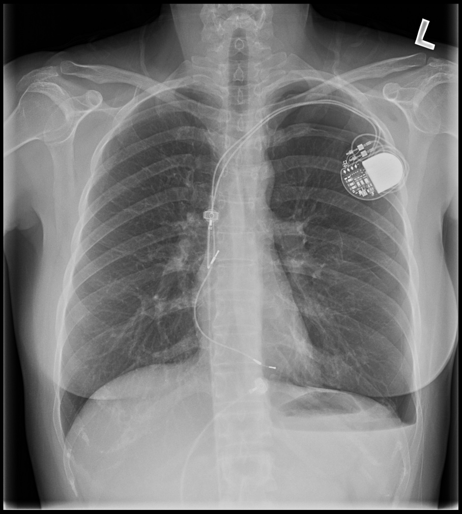 pneumothorax_post_ppm.jpg