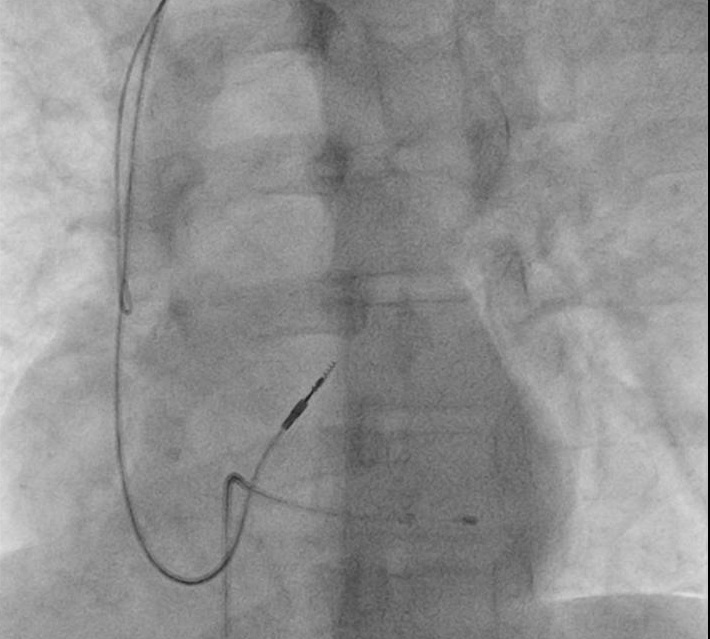 rvot_before_screw.jpg