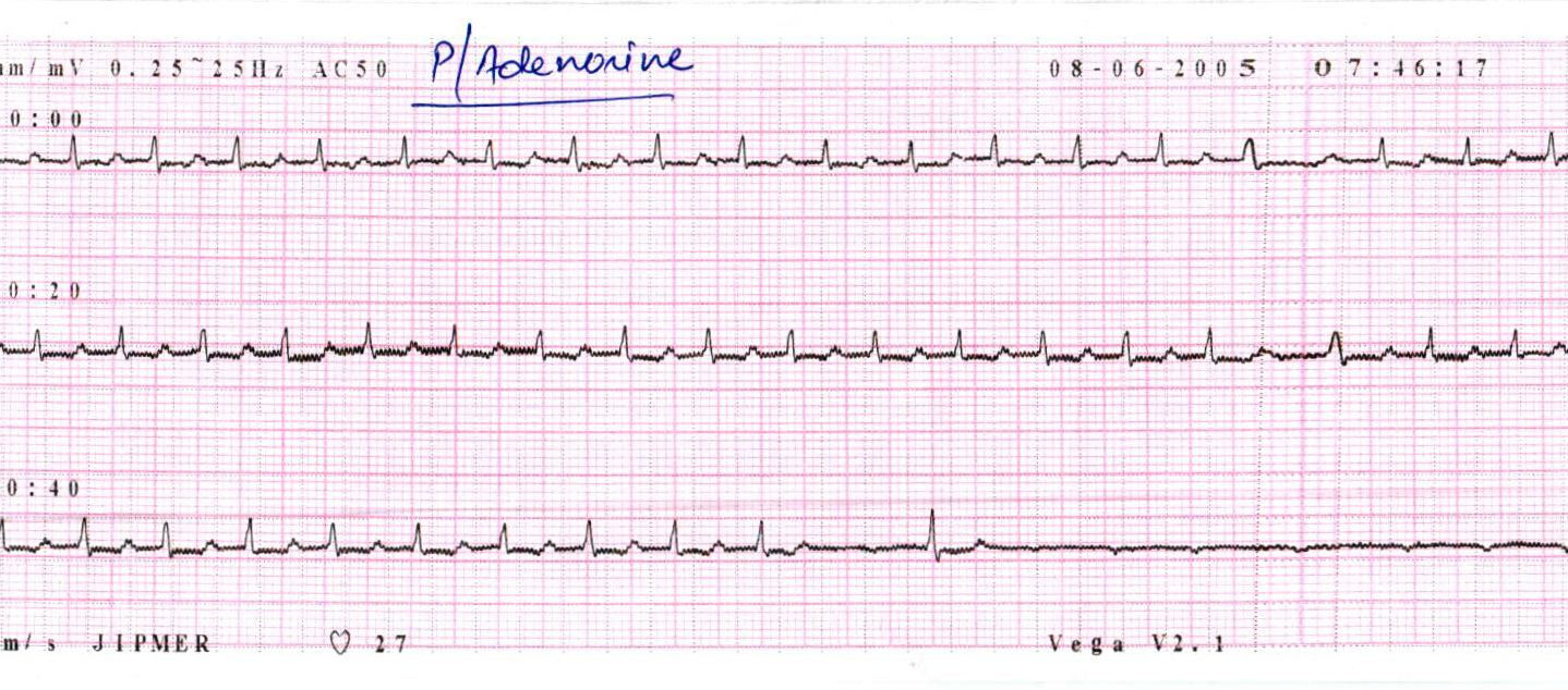 adenosine_atrial_flutter.jpg