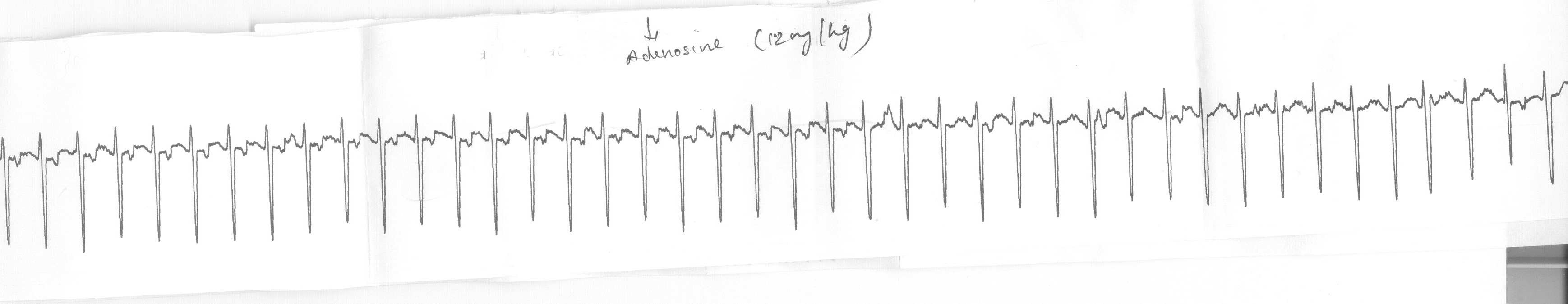 adenosine_va_block.jpg