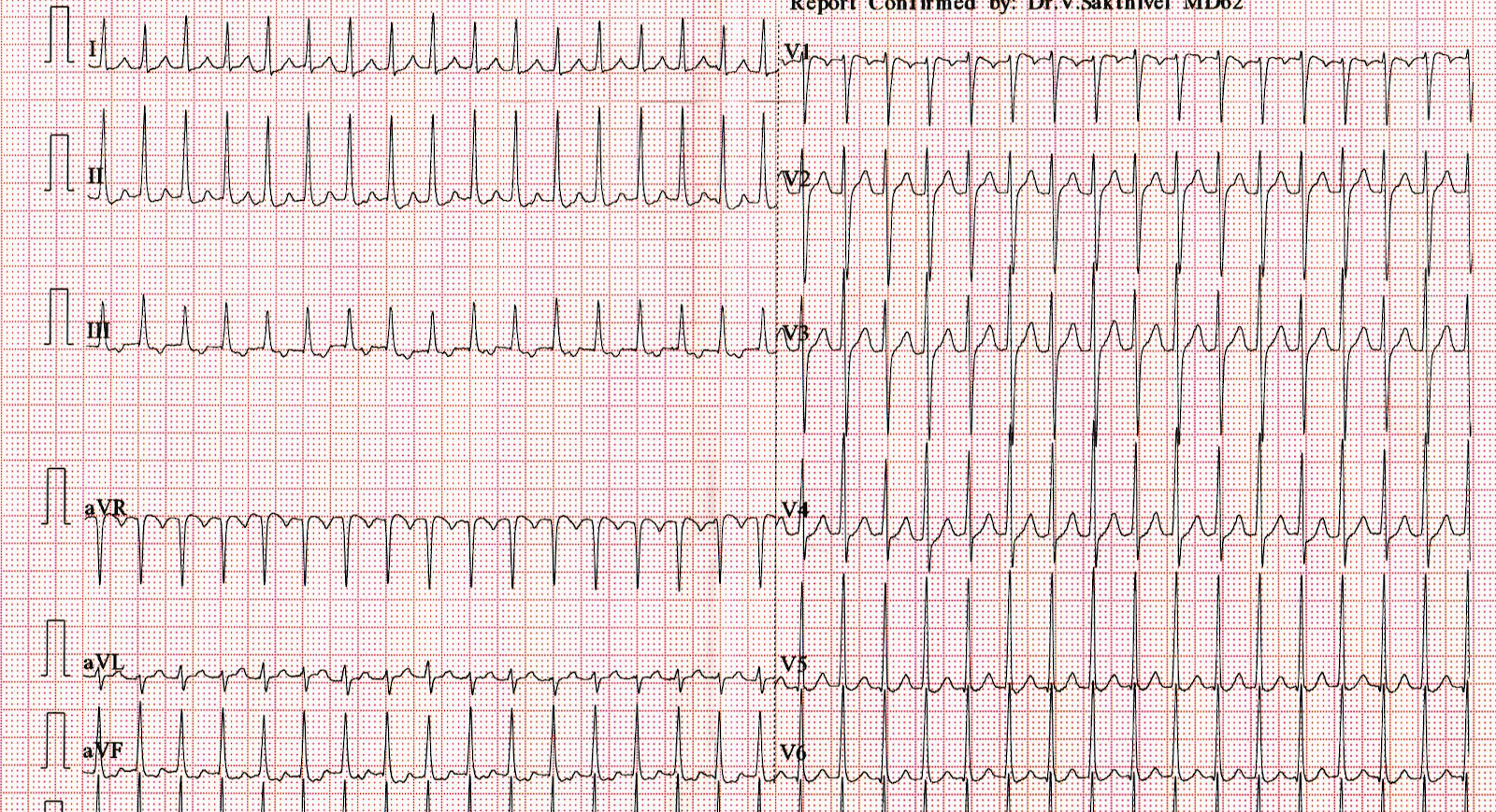 avrt_qrs_alternans.jpg