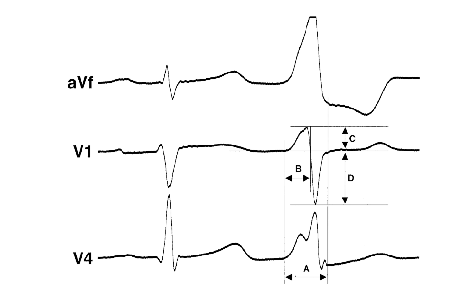 ecg_ot.png