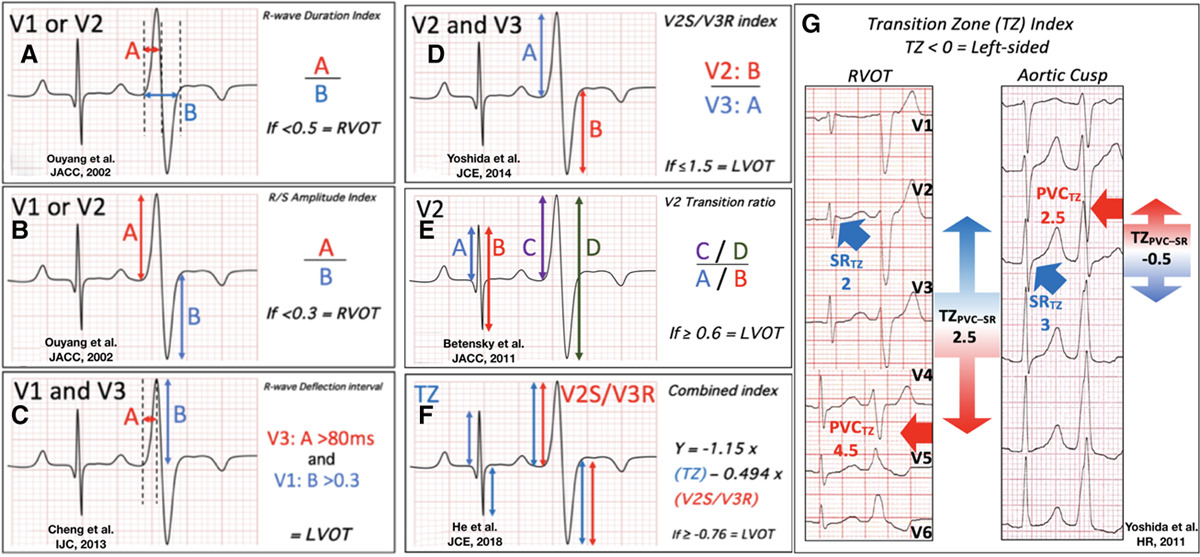 lv_or_rv_ecg.jpg