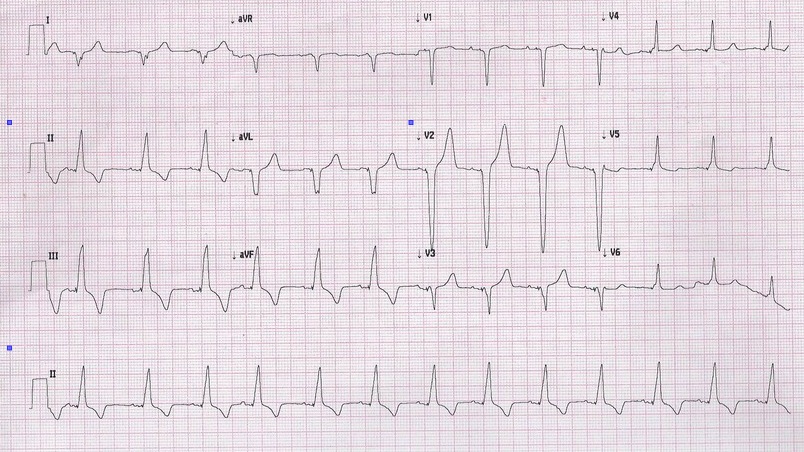rvot_pacing_ecg.jpg