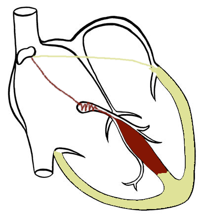 adenosine_mild_preexcitation_schematic.png