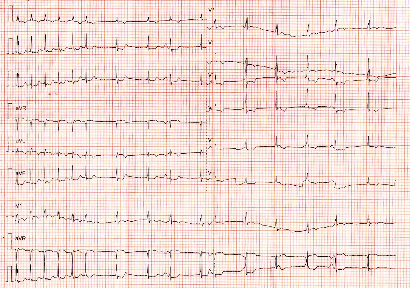 adenosine_ecg.jpg