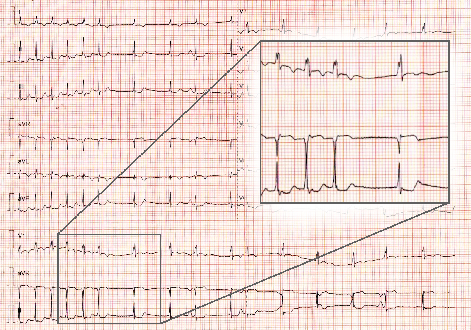 adenosine_ecg_inset.jpg