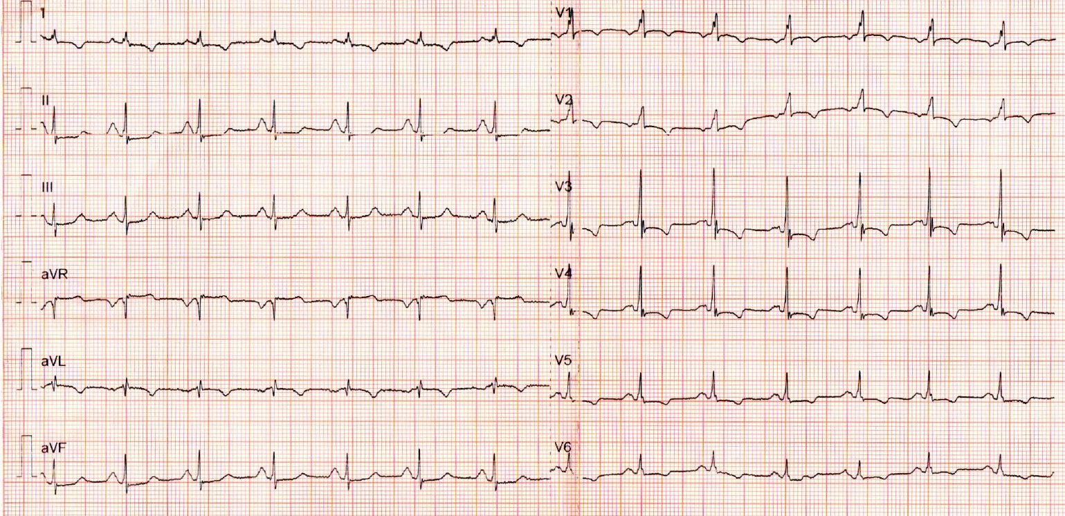 sinus_ecg.jpg