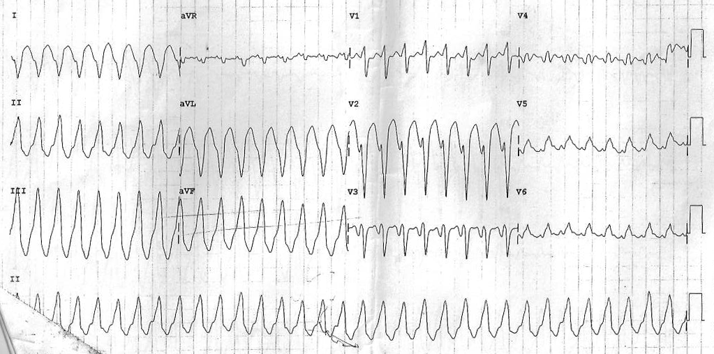 vt_ecg.png
