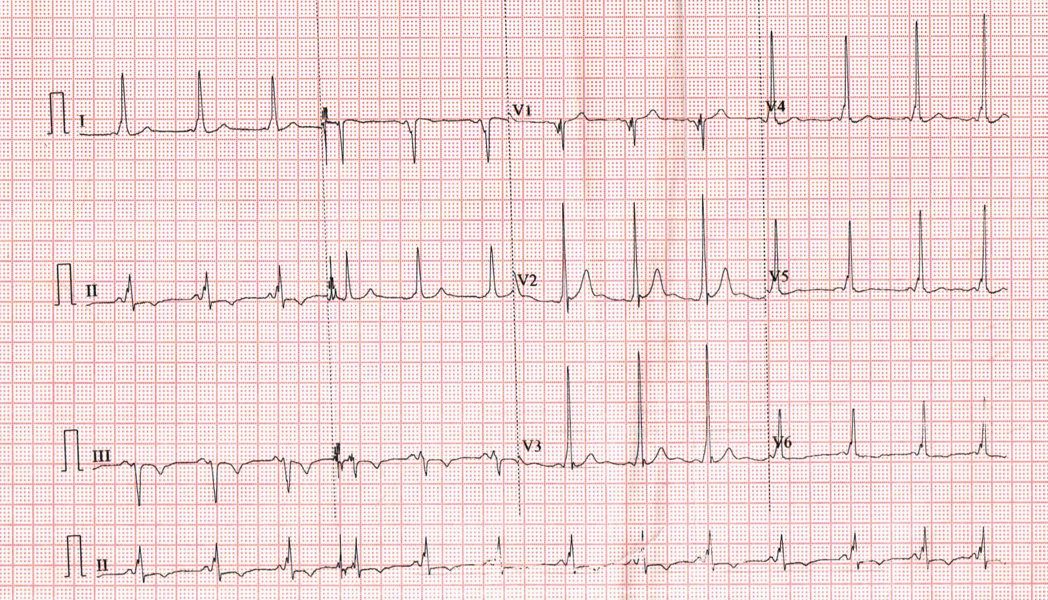 midseptal_ECG.jpg