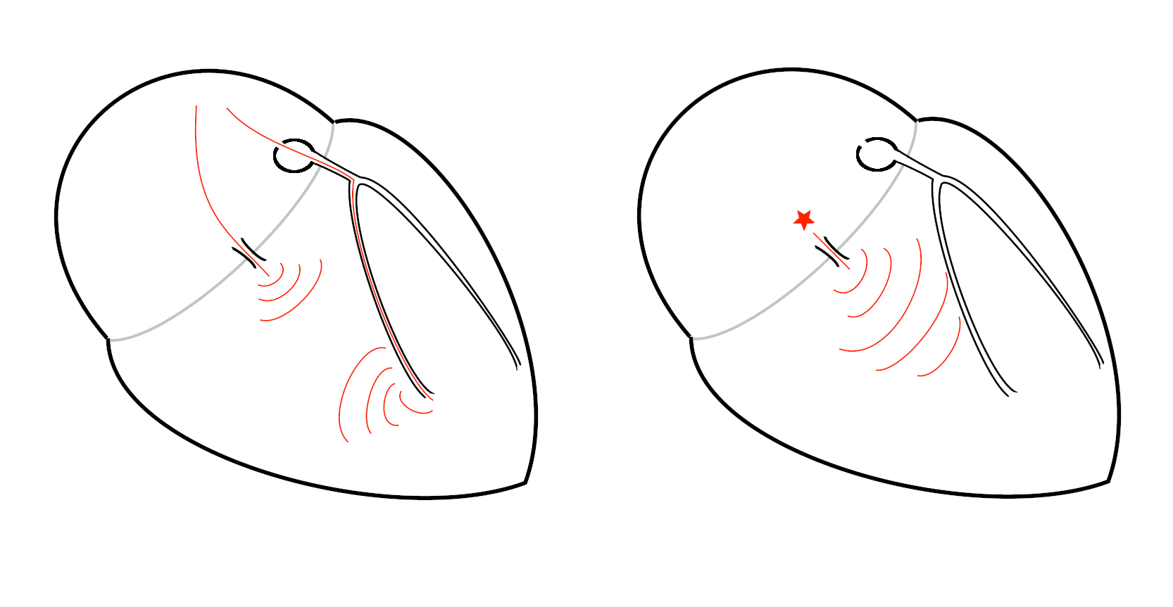 v_insertion.png