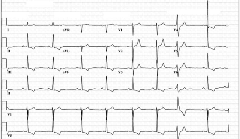 mvp_ecg.jpg
